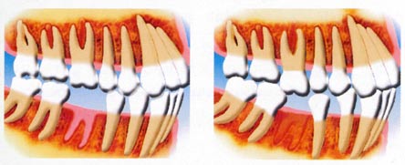 ponti Schema dente mancante