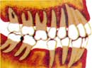 protesi-mobile-scheletrata-2 Spostamento dei denti: spostamento dopo la caduta del dente